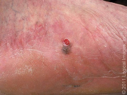 Melanoma Lentiginoso acral 2