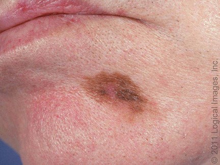 Melanoma Lentigo maligno 1