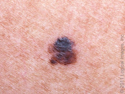 Melanoma de extension o diseminacion superficial 2