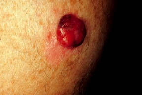 Melanoma de tipo nodular