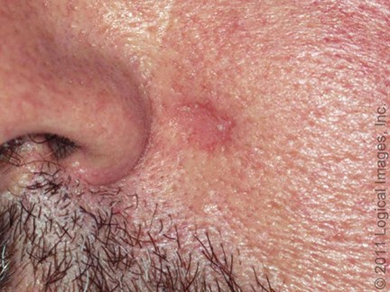 carcinoma Morfeiforme o esclerosante