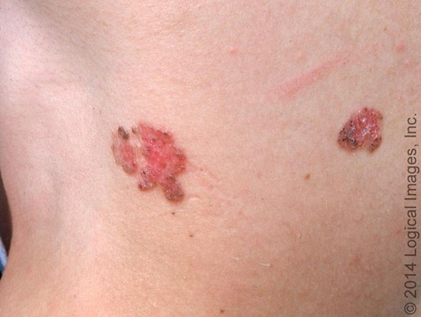 carcinoma superficial