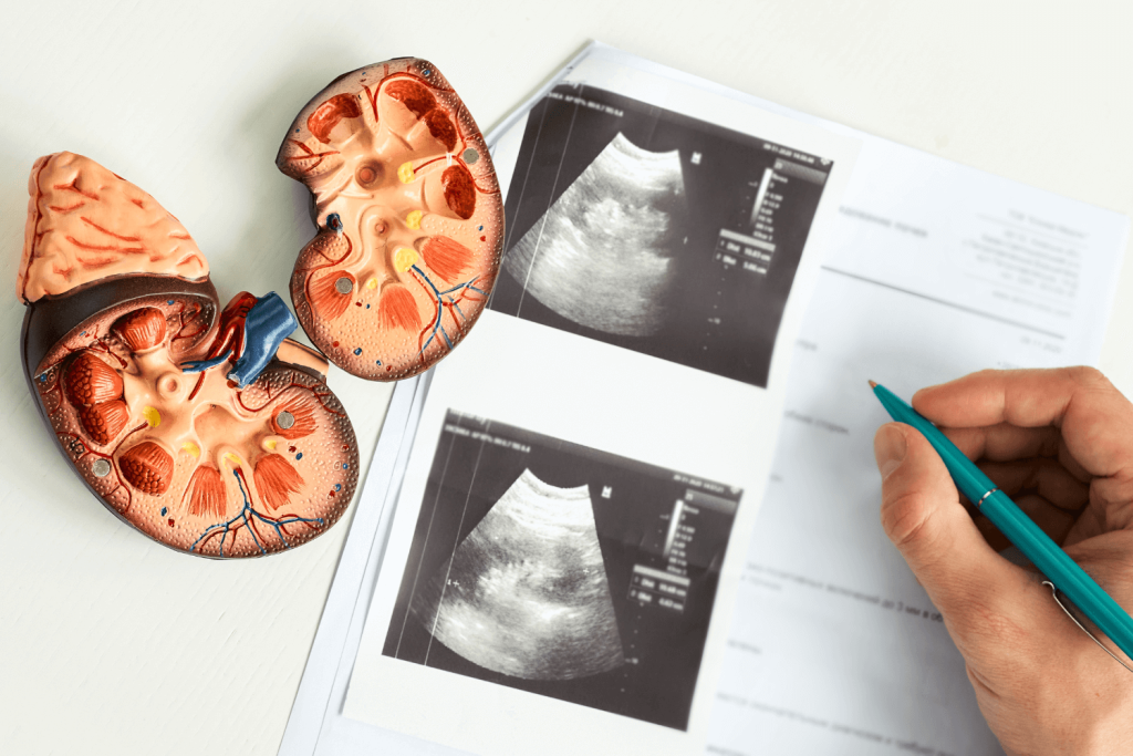 Diagnóstico del cáncer renal en CDMX